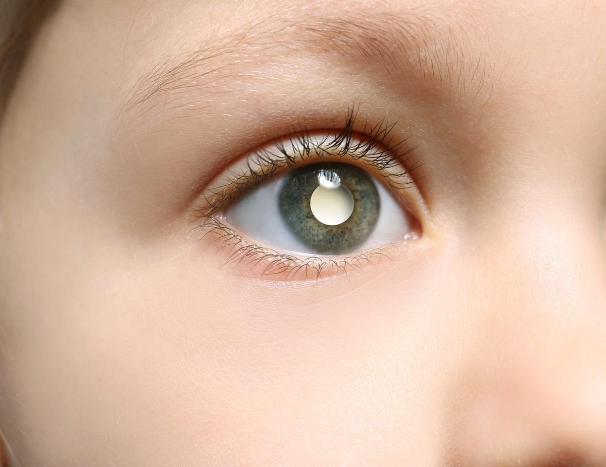 Retinoblastoma